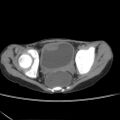 Colocolic fistula - Crohn disease (Radiopaedia 57063-63955 A 82).jpg