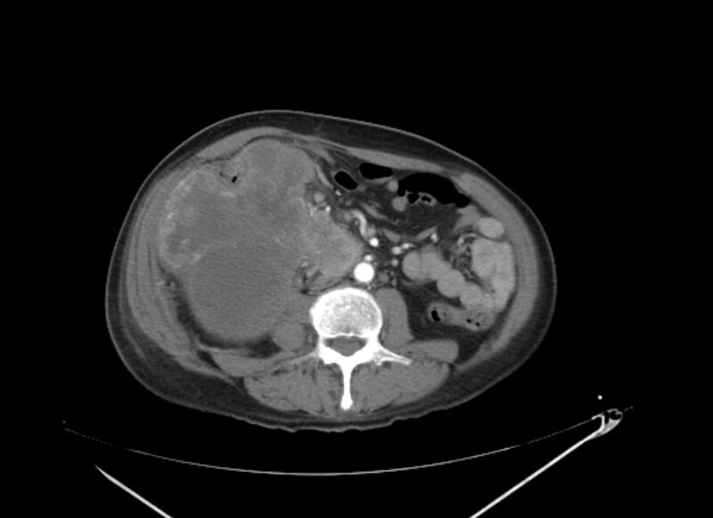 File:Colon cancer mimicking renal cell carcinoma (Radiopaedia 28986-29335 B 41).jpg