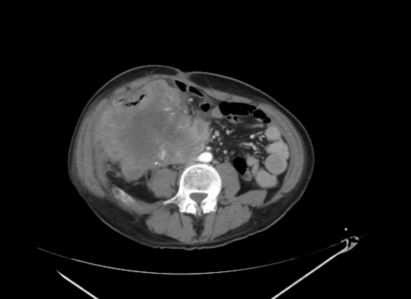 File:Colon cancer mimicking renal cell carcinoma (Radiopaedia 28986-29335 B 45).jpg