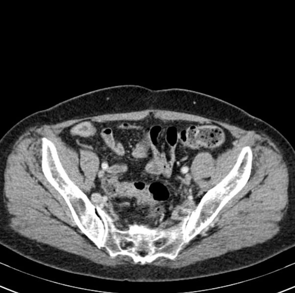 File:Colon carcinoma with hepatic metastases (Radiopaedia 29477-29961 A 93).jpg