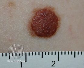 Compound naevus (DermNet NZ doctors-lesions-images-bml2).jpg