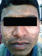 Steroid-induced hypopigmentation