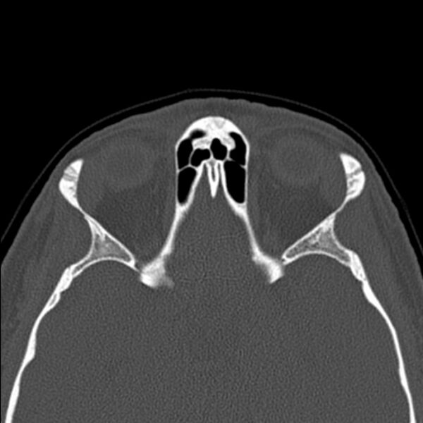 File:Nasal septal perforation (Radiopaedia 25030-25289 Axial bone window 50).jpg
