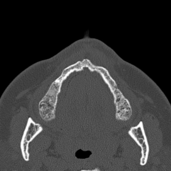 File:Nasolabial cyst (Radiopaedia 33987-35205 Axial bone window 1).jpg