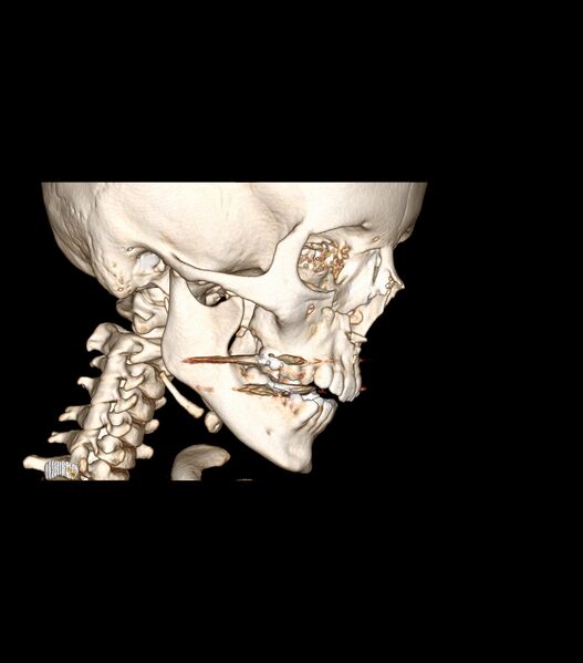 File:Nasoorbitoethmoid fracture (Radiopaedia 90044-107205 3D VRT 5).jpg