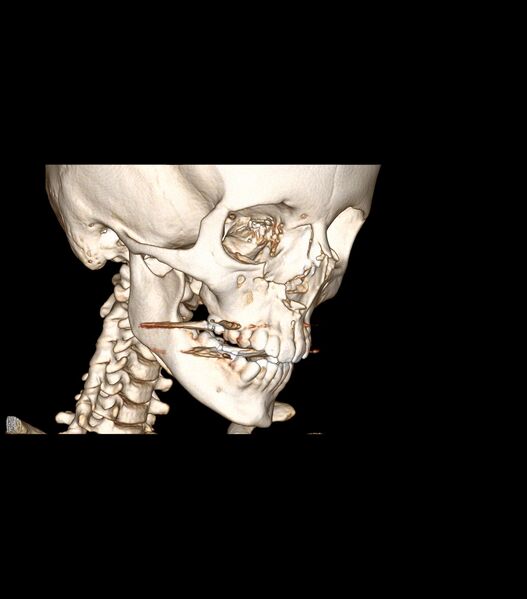 File:Nasoorbitoethmoid fracture (Radiopaedia 90044-107205 3D VRT 9).jpg