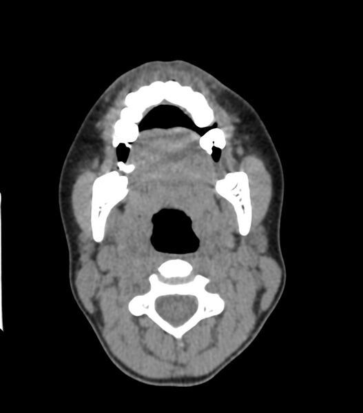 File:Nasoorbitoethmoid fracture (Radiopaedia 90044-107205 Axial non-contrast 79).jpg