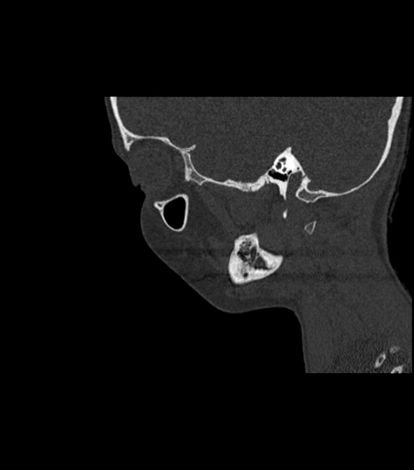 Nasoorbitoethmoid fracture (Radiopaedia 90044-107205 Sagittal bone window 41).jpg