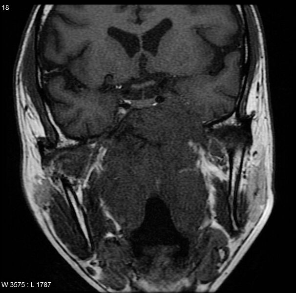 File:Nasopharyngeal carcinoma (Radiopaedia 4546-6667 Coronal T1 1).jpg