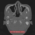 Nasopharyngeal carcinoma recurrence - skull base destruction (Radiopaedia 29107-29490 Axial bone window 97).jpg