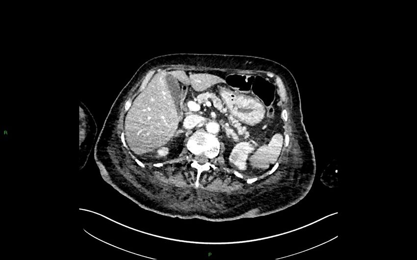 Neo-terminal ileal stricture (Crohn disease) (Radiopaedia 33790-34948 A 130).jpg