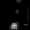 Neonatal neuroblastoma (Radiopaedia 56651-63438 C 9).jpg