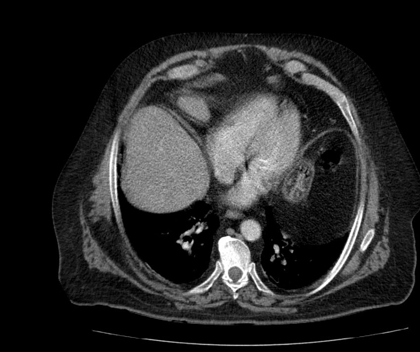 Nephroptosis with inguinal hernia containing perirenal fat (Radiopaedia 56632-63391 C 41).jpg