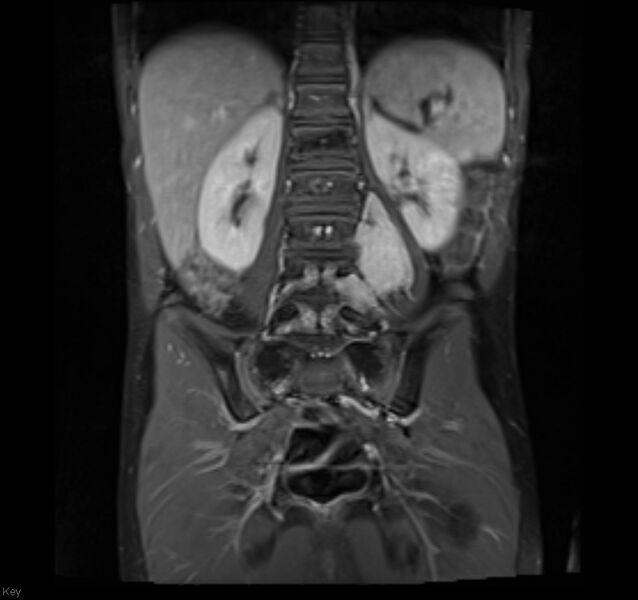 File:Neuroblastoma (Radiopaedia 6010-7518 Coronal T1 fat sat 2).jpg