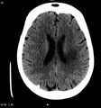 Neurocysticercosis (Radiopaedia 7773-8596 non-contrast 9).jpg