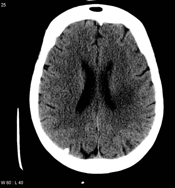 File:Neurocysticercosis (Radiopaedia 7773-8596 non-contrast 9).jpg
