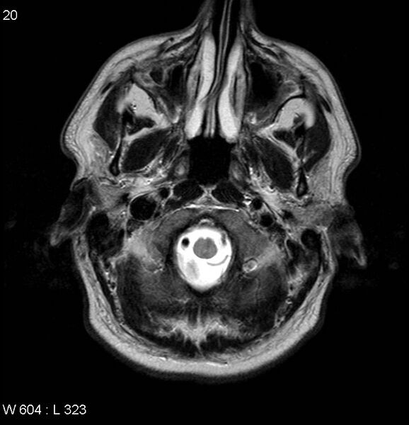 File:Neurosarcoidosis (Radiopaedia 10930-17204 Axial T2 1).jpg