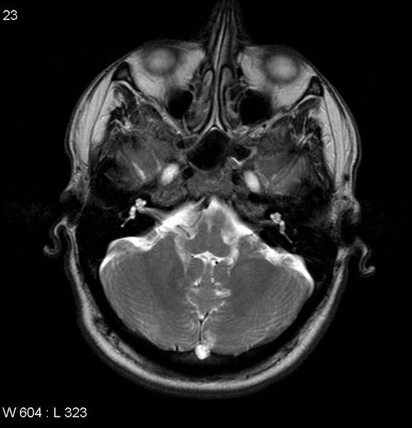 File:Neurosarcoidosis (Radiopaedia 10930-17204 Axial T2 4).jpg