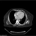 Non-Hodgkin lymphoma (Radiopaedia 27492-27690 A 1).jpg