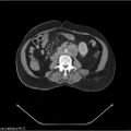 Non-Hodgkin lymphoma (Radiopaedia 27492-27690 B 4).jpg
