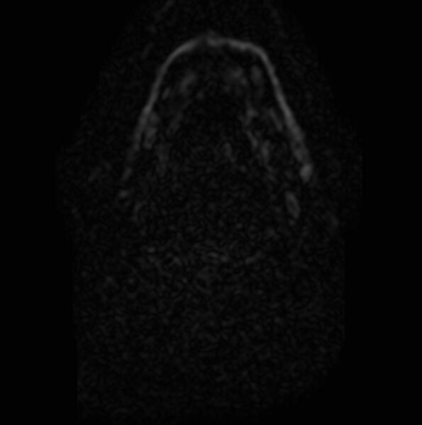 File:Non-Hodgkin lymphoma - parotid gland (Radiopaedia 71531-81890 Axial DWI 4).jpg