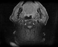 Non-Hodgkin lymphoma - parotid gland (Radiopaedia 71531-81890 T1 fat sat 9).jpg