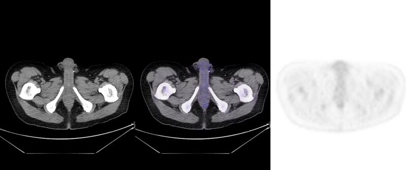 File:Non-Hodgkin lymphoma involving seminal vesicles with development of interstitial pneumonitis during Rituximab therapy (Radiopaedia 32703-33752 ax CT Fus PET 65).jpg