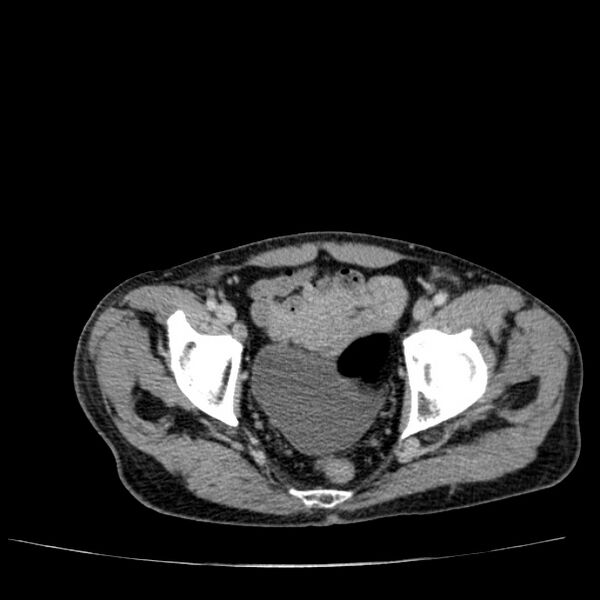 File:Non small-cell lung cancer (Radiopaedia 24467-24769 C+ delayed 110).jpg