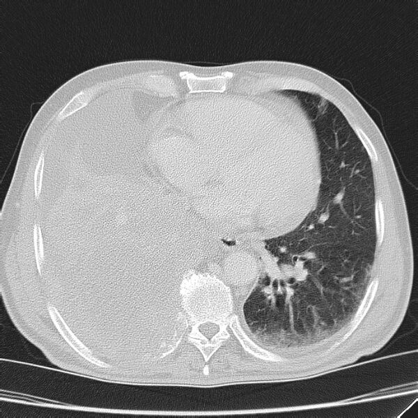 File:Non small-cell lung cancer (Radiopaedia 24467-24769 lung window 35).jpg