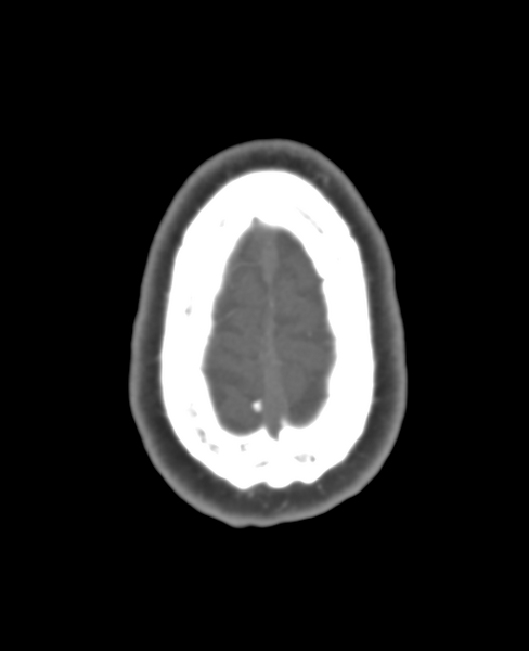 File:Normal CTA head (Radiopaedia 40801-43464 A 12).png