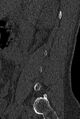 Normal CT lumbar spine (Radiopaedia 53981-60118 Sagittal bone window 10).jpg