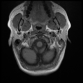 Normal cervical and thoracic spine MRI (Radiopaedia 35630-37156 Axial T1 32).png