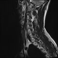 Normal cervical spine MRI (Radiopaedia 38418-40496 Sagittal T2 12).jpg