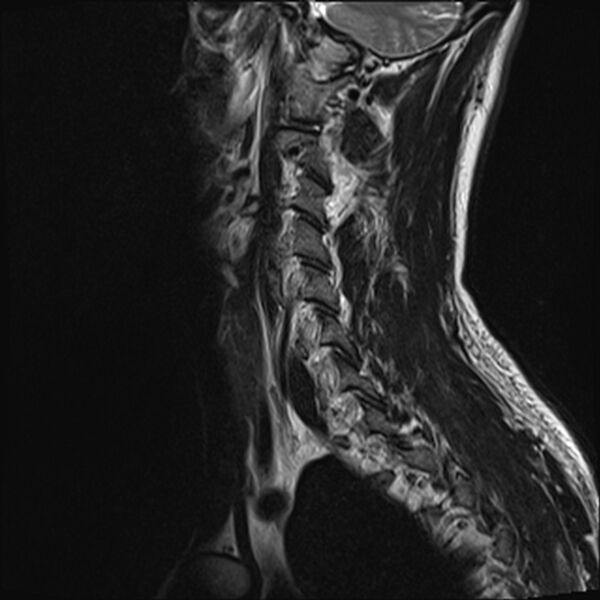 File:Normal cervical spine MRI (Radiopaedia 38418-40496 Sagittal T2 12).jpg