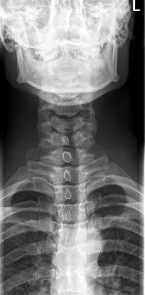 File:Normal cervical spine radiographs (Radiopaedia 32505-33464 Frontal 1).jpg