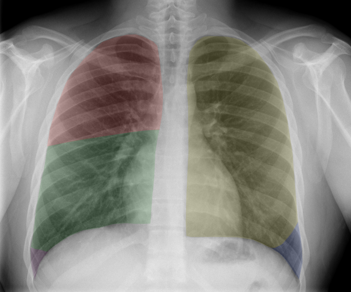 File:Normal chest x-ray - lobes (illustration) (Radiopaedia 58938-66192 PA 1).png