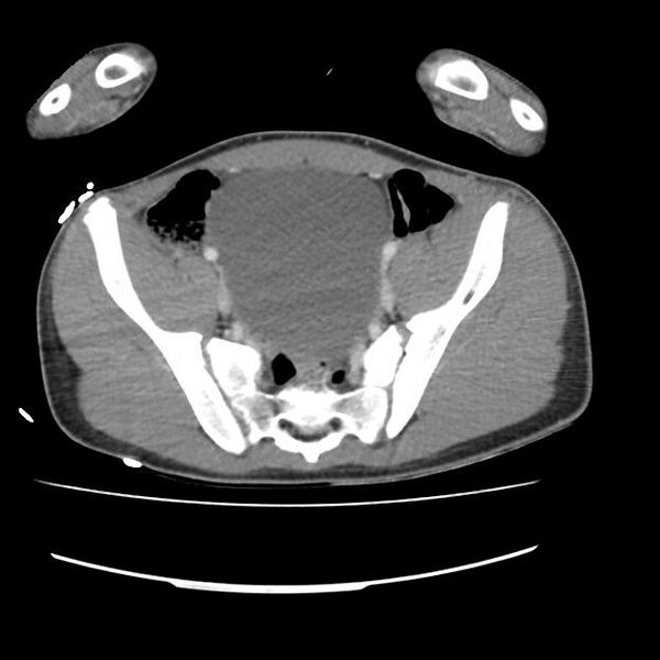 File:Normal dual-phase trauma CT chest,abdomen and pelvis (Radiopaedia 48092-52899 A 96).jpg