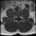 Normal lumbar spine MRI (Radiopaedia 35543-37039 Axial T1 22).png