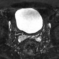 Normal prostate (MRI) (Radiopaedia 29986-30535 Axial STIR 22).jpg