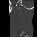 Normal trauma cervical spine (Radiopaedia 41017-43760 Sagittal bone window 47).png