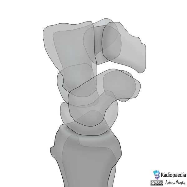 File:Normal wrist alignment, dorsal and volar intercalated segmental instability (illustration) (Radiopaedia 80949-94488 A 1).png