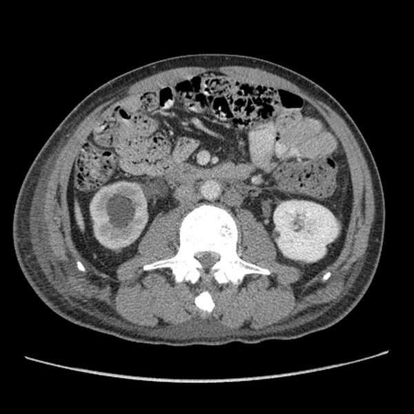 File:Obstructive bladder transitional cell carcinoma (Radiopaedia 9825-10410 A 12).jpg