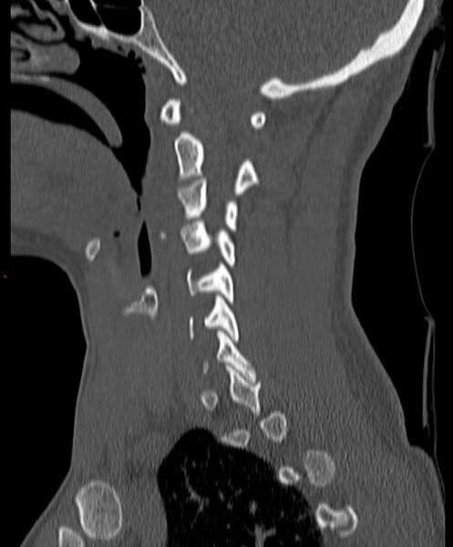 File:Occipital condyle fracture (Radiopaedia 61165-69056 Sagittal bone window 10).jpg