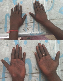 Image of hands showing hyperpigmentation