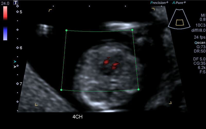 File:1st trimester nuchal-morphology ultrasound (Radiopaedia 44706-48477 Heart views cine with colour 28).jpg