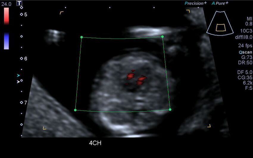 1st trimester nuchal-morphology ultrasound (Radiopaedia 44706-48477 Heart views cine with colour 28).jpg