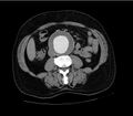 Abdominal aortic aneurysm (Radiopaedia 11151).jpg