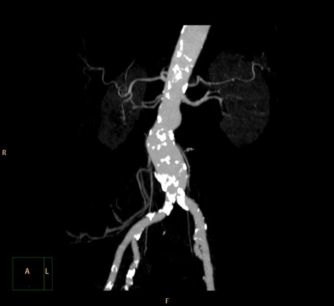 File:Abdominal aortic aneurysm (Radiopaedia 23703-23856 MIP 25).jpg