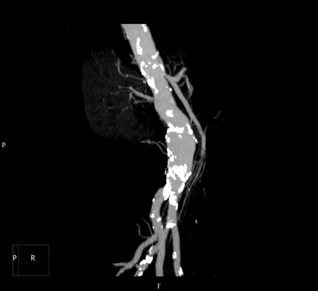 File:Abdominal aortic aneurysm (Radiopaedia 23703-23856 MIP 8).jpg