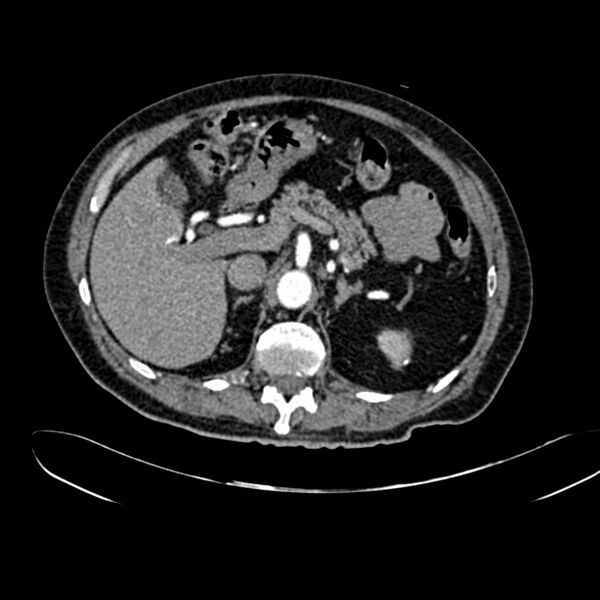 File:Abdominal aortic aneurysm (Radiopaedia 75131-86203 Axial C+ arterial phase 14).jpg